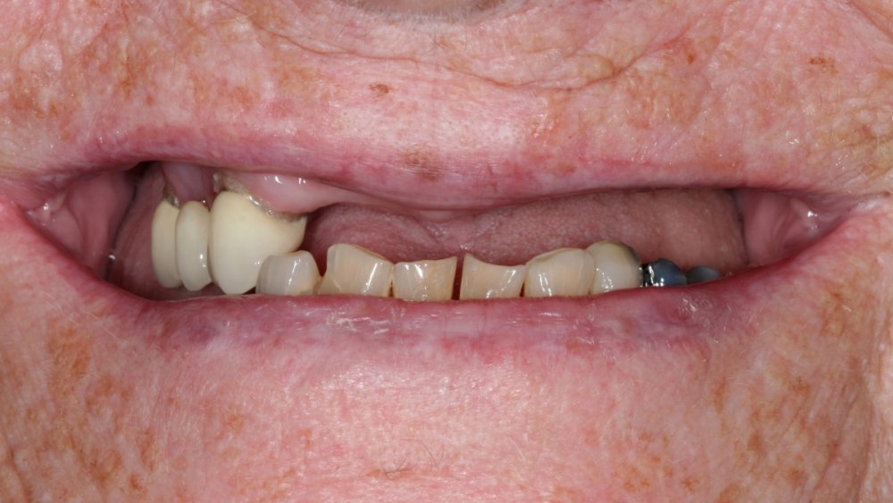implant_teeth_in_a_day-1a.thumb.jpg.5c39f0c37ae194e6933b369046df311a.jpg